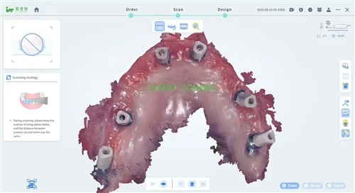 Real Clinical Case: Aident AI-30 Intraoral Scanner Completes Full Implant Restoration Workflow Real Clinical Case: Aident AI-30 Intraoral Scanner Completes Full Implant Restoration Workflow